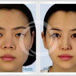 Bí kíp giải quyết mũi gãy cho các bạn gái xinh đẹp Bí kíp giải quyết mũi gãy cho các bạn gái xinh đẹp