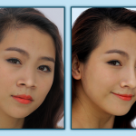 Nâng mũi bọc sụn có đau không? Nâng mũi bọc sụn có đau không?