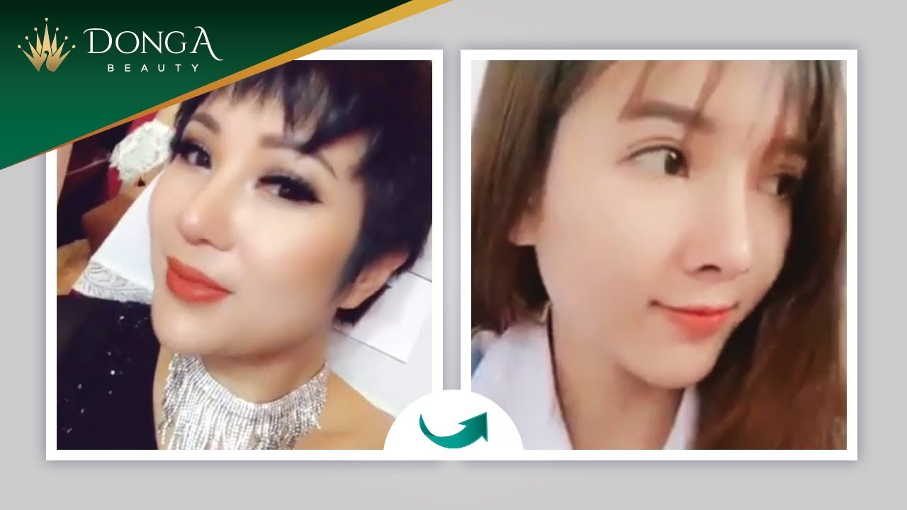 Feedback khách hàng nâng mũi S Line tại Đông Á