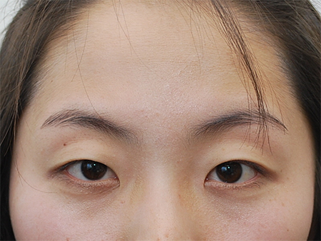 Giá cắt mí mắt ở Đông Á là bao nhiêu?