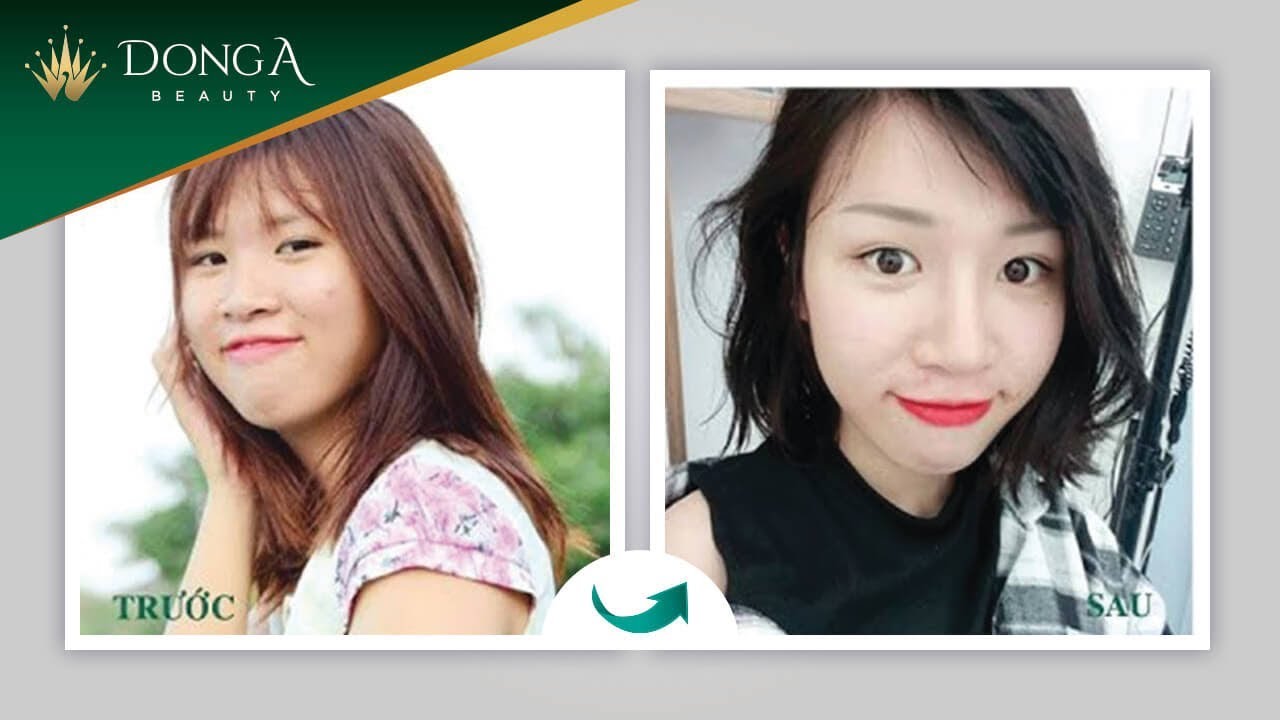 Kết quả sau khi nâng mũi S Line Dr Park – Khách hàng Linh Rin