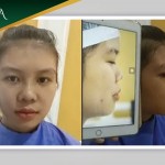 Cận cảnh hình ảnh khách hàng nâng mũi S Line cấu trúc sau 10 ngày Cận cảnh hình ảnh khách hàng nâng mũi S Line cấu trúc sau 10 ngày