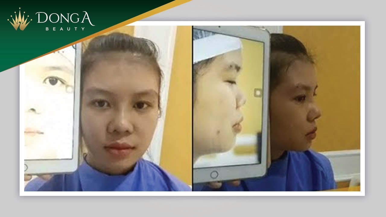 Cận cảnh hình ảnh khách hàng nâng mũi S Line cấu trúc sau 10 ngày