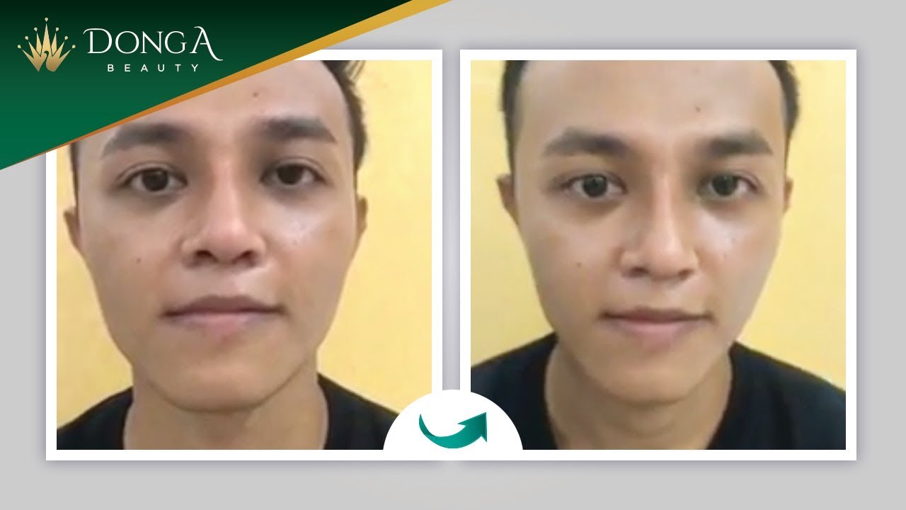 Xem ngay kết quả sau 1 tháng nâng mũi Sline cho nam giới tại Đông Á