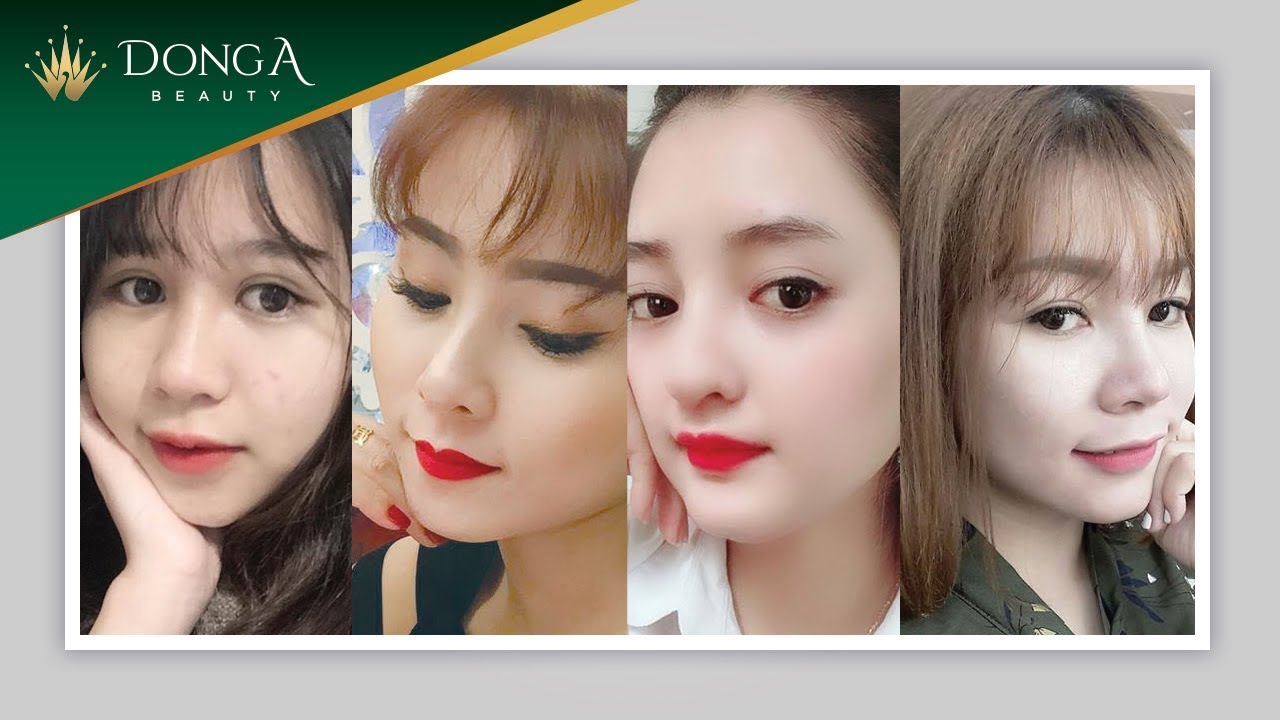 10+ ca thẩm mỹ nâng mũi đẹp ngoạn mục tại Đông Á