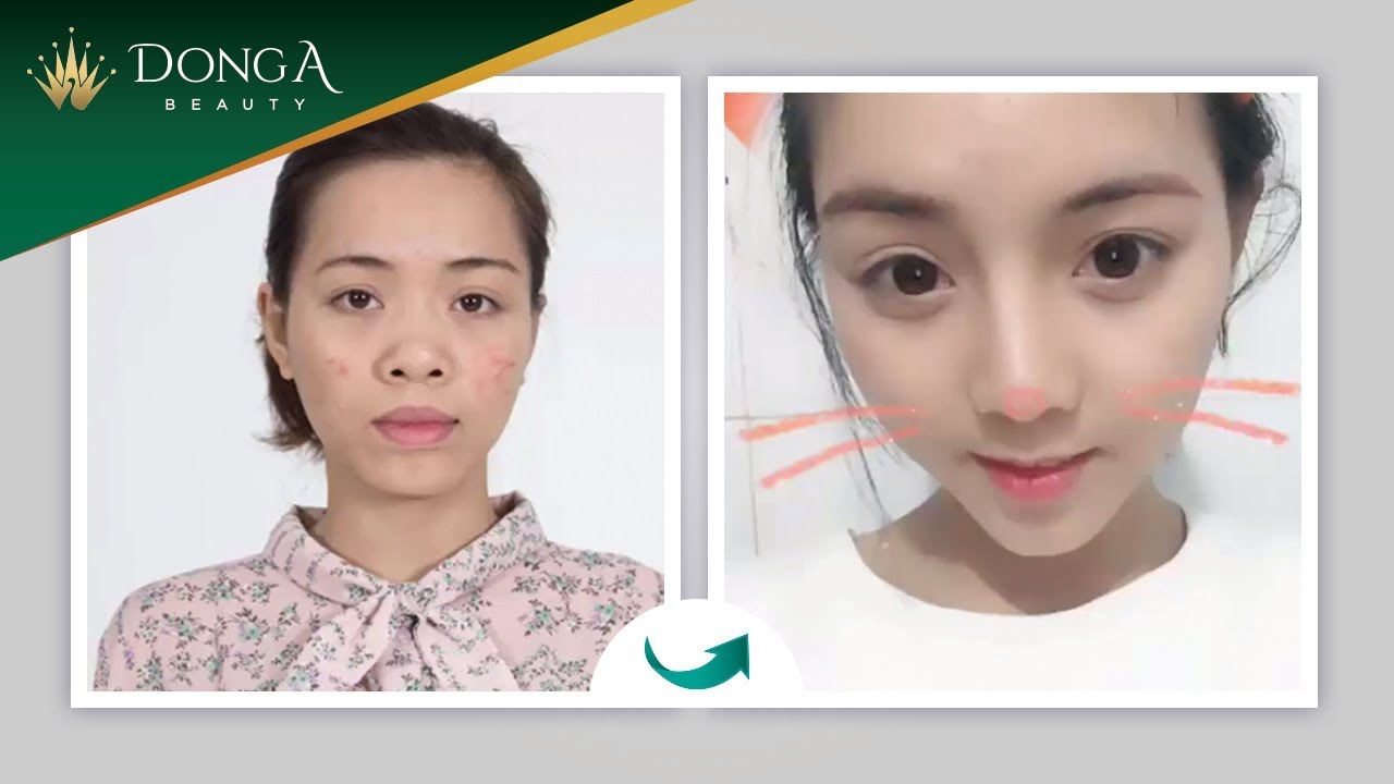 Loại bỏ khuyết điểm mũi hếch, đầu mũi ngắn nhờ nâng mũi Dr Park