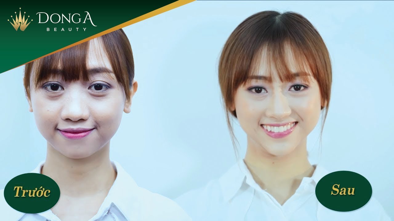 Nâng mũi không phẫu thuật tại Thẩm mỹ viện Đông Á
