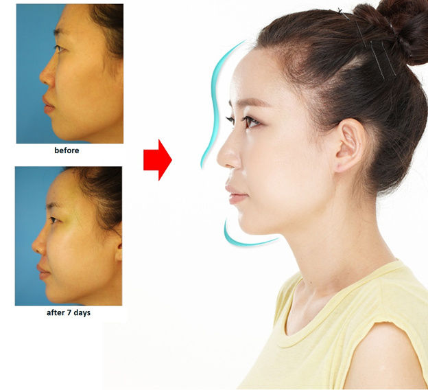Nâng mũi S line là phương pháp thẩm mỹ mũi đảm bảo an toàn