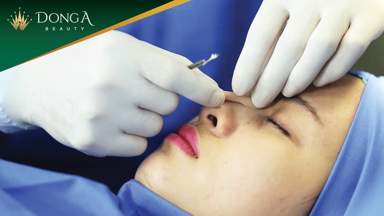 Nâng mũi S Line chất liệu 5S Nano độc quyền tại Đông Á