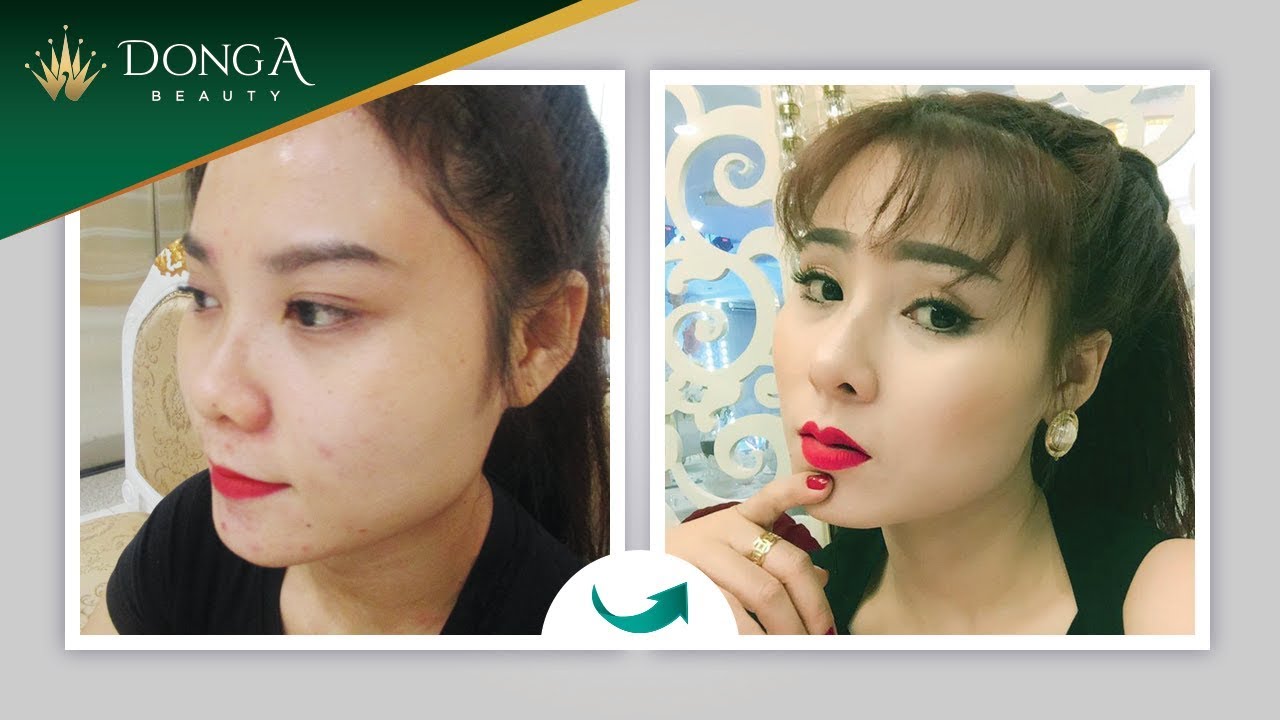 Nâng mũi Sline đẹp an toàn tự nhiên tại Đông Á