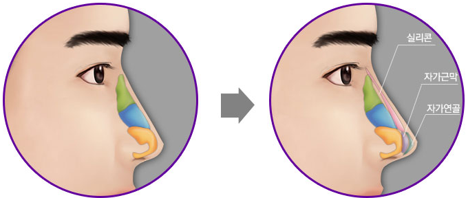 Phẫu thuật nâng mũi bọc sụn đảm bảo an toàn