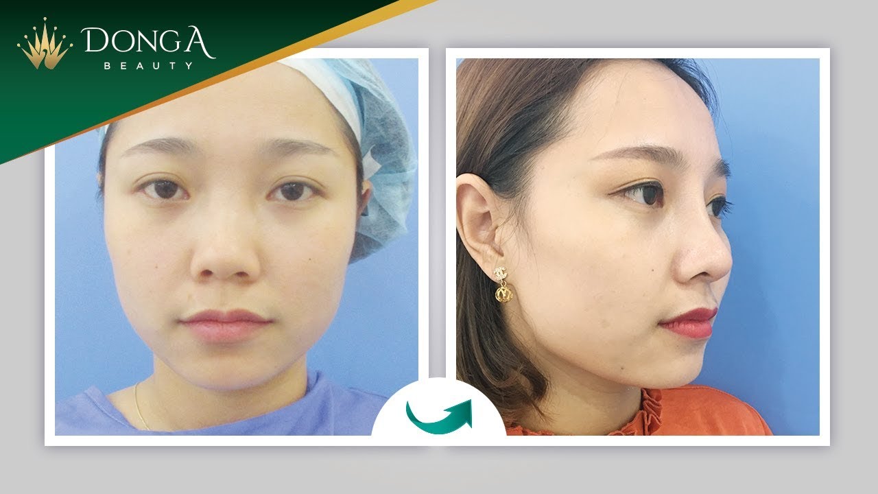 Cùng khách hàng đến tái khám sau thẩm mỹ nâng mũi Sline Dr Park