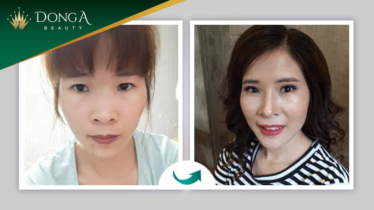 Vân Anh tái khám sau 15 ngày Cắt mí + Nâng mũi tại Đông Á