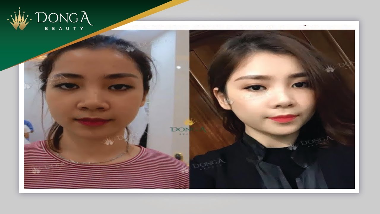 Mô phỏng phẫu thuật thu gọn cánh mũi Hàn Quốc tại Đông Á