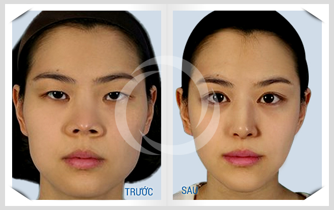 Hình ảnh trước và sau khi thu gọn mũi bằng công nghệ Hàn Quốc